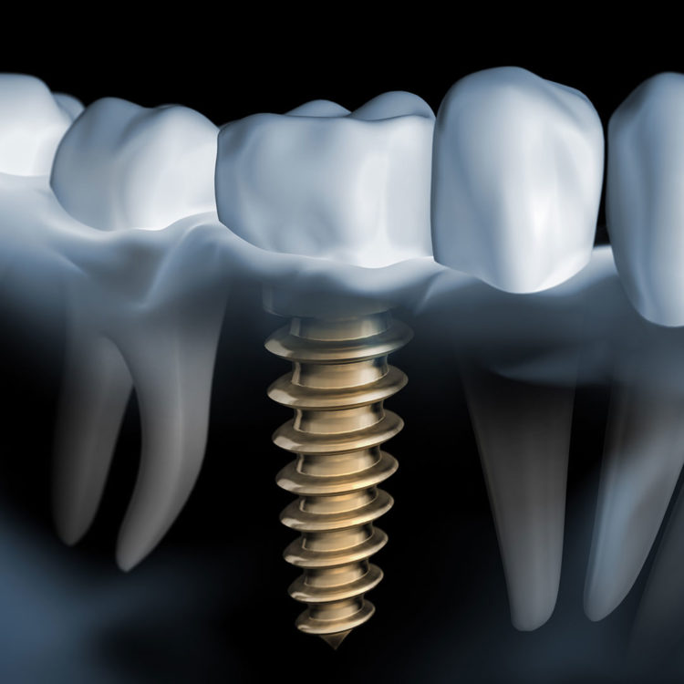 dental-clinic-kovacevic-zubni-implanti