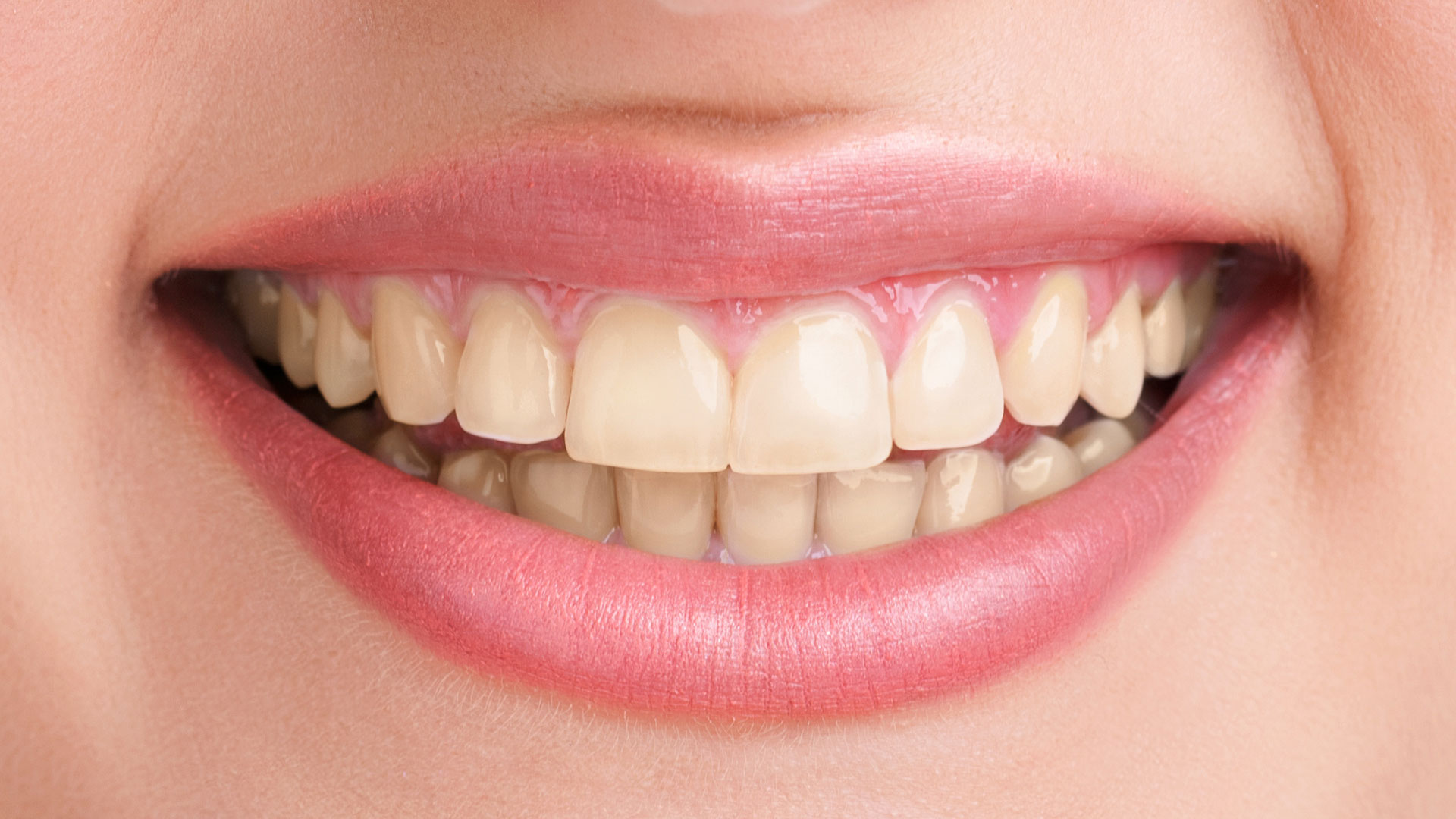 dental-clinic-kovacevic-izbjeljivanje-zuba-prije