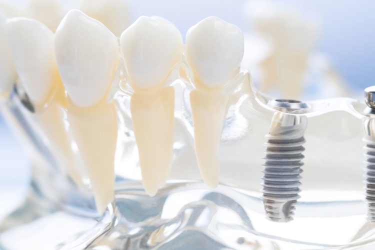 dental-clinic-kovacevic-ugradnja-zubnih-implantata